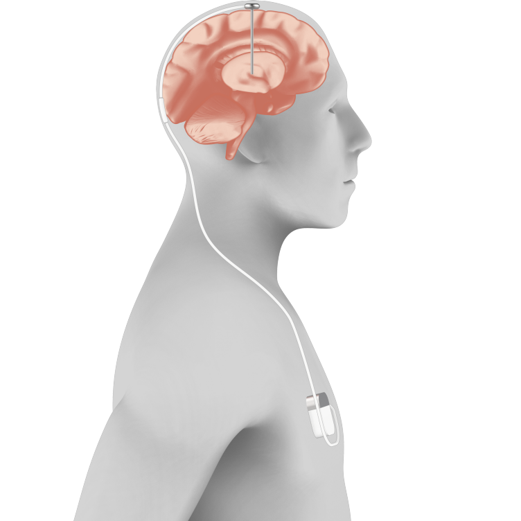 Enlarged view: Visualisation Neurofeedback based on Deep Brain Stimulation